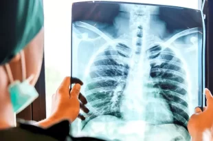 Cáncer de pulmón en Argentina
