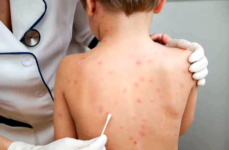 Kreplak Sarampión otra de las emfermadades que regresan