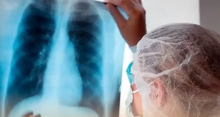 Aumentan de casos de tuberculosis