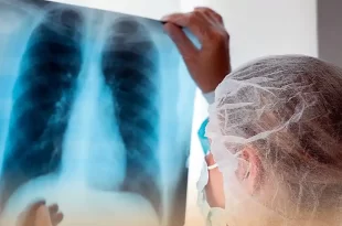 Aumentan de casos de tuberculosis