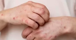 Alerta sanitaria por el aumento de la sífilis en Argentina