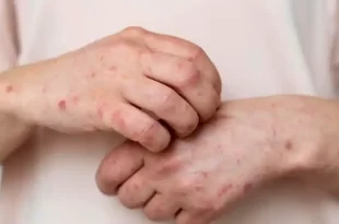 Alerta sanitaria por el aumento de la sífilis en Argentina