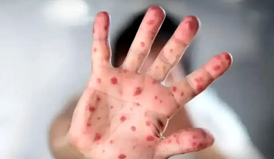 variante de viruela Mpox Clado Ib