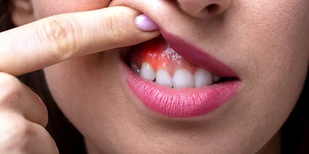 prevenir el cáncer bucal