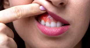 prevenir el cáncer bucal