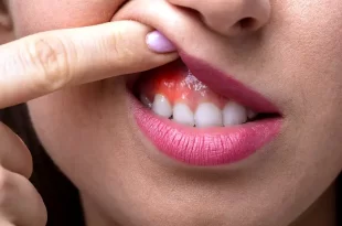 prevenir el cáncer bucal